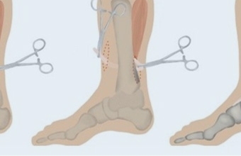 Footdrop - a New Treatment