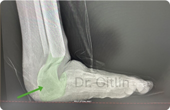 Grow a New Foot