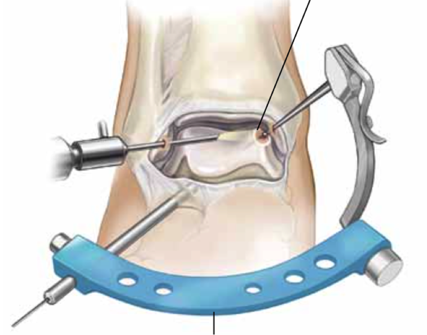 Arthritis2