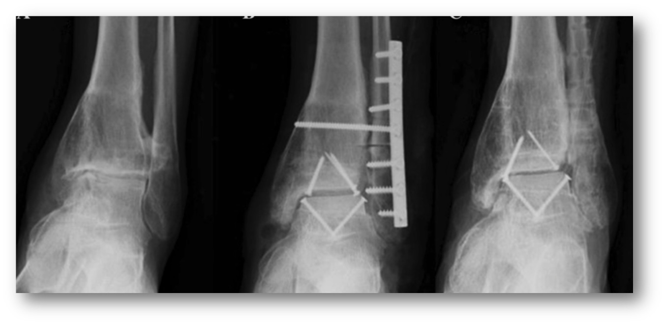 Arthritis5