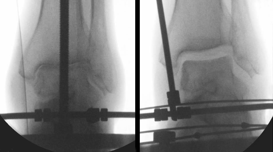 Arthritis6