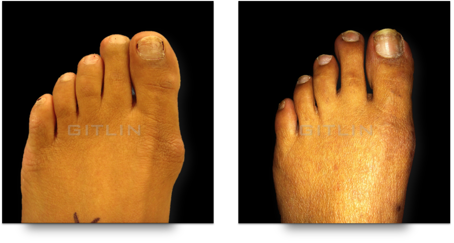 bunion1