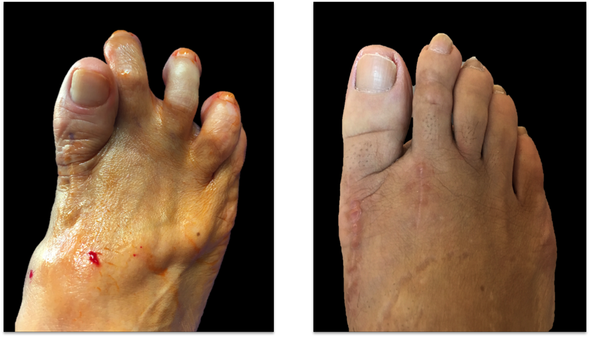 bunion10