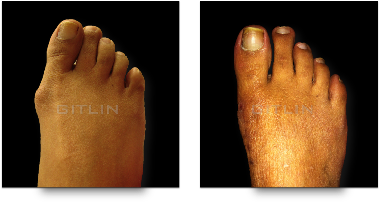 bunion2