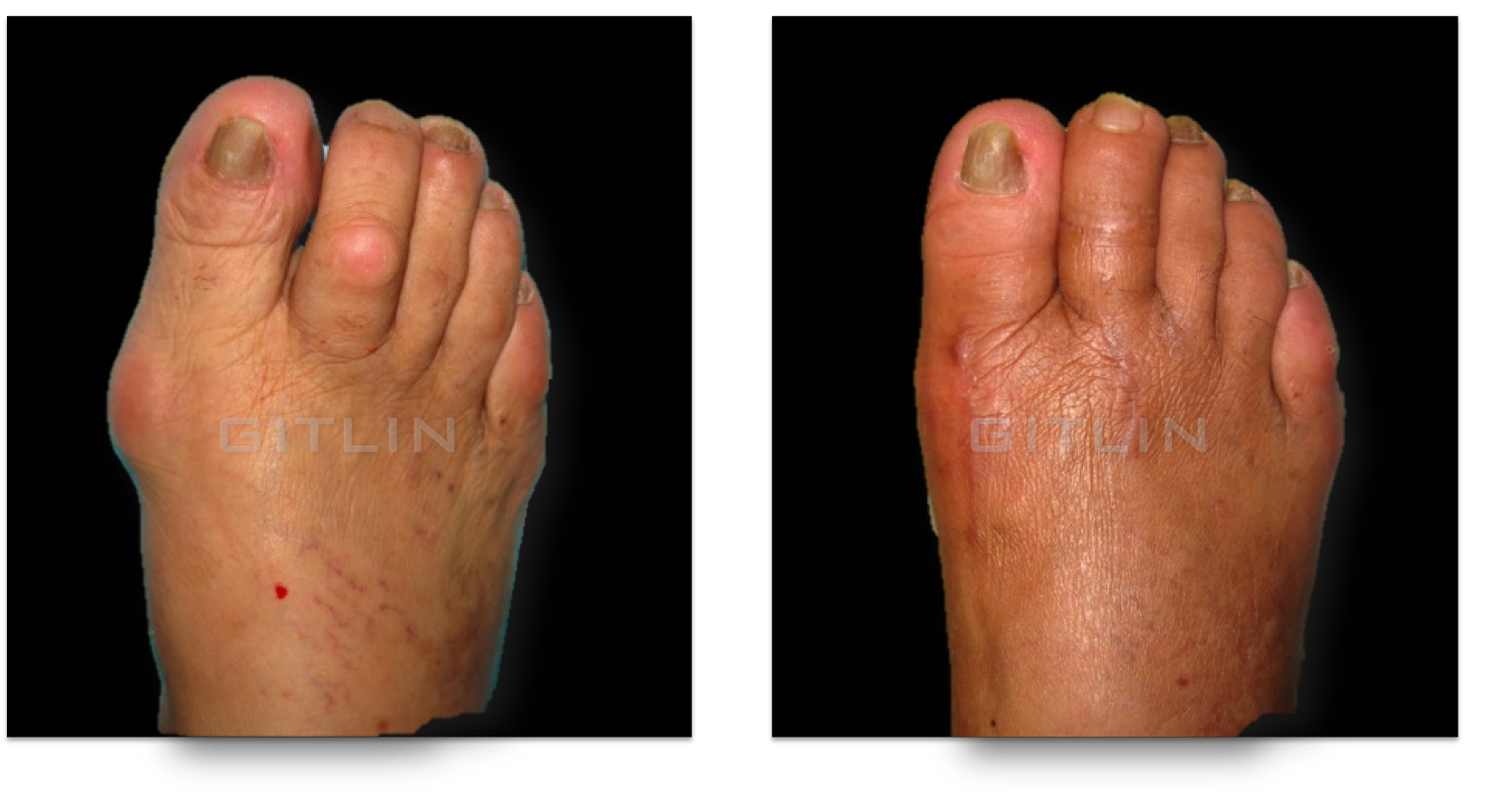 bunion3