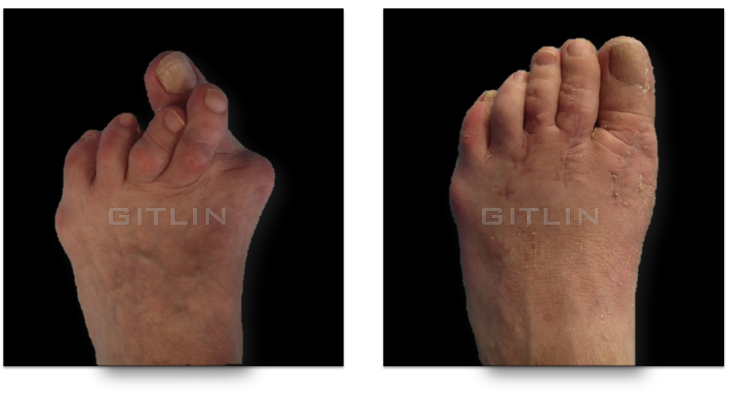 bunion4