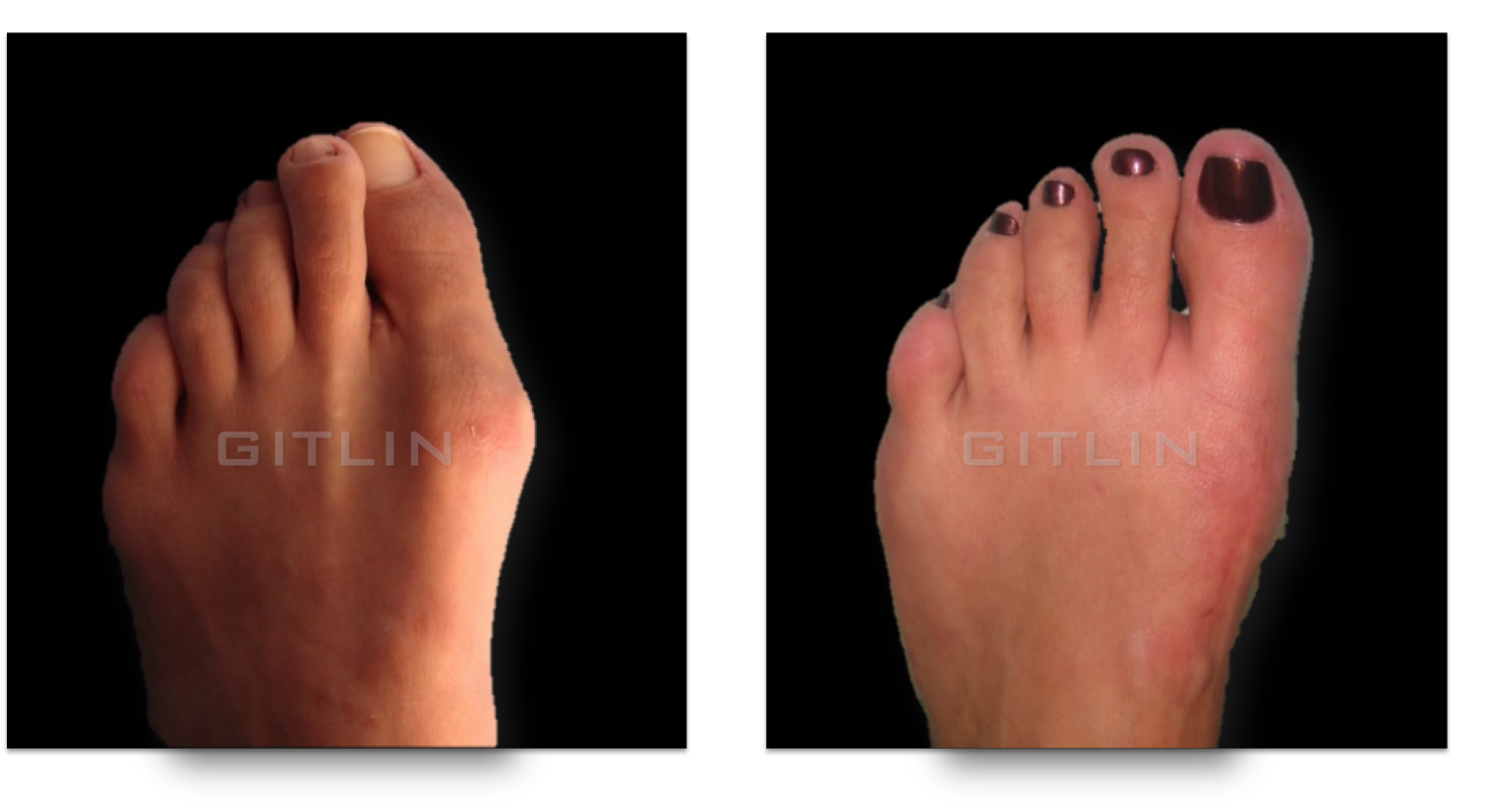 bunion6