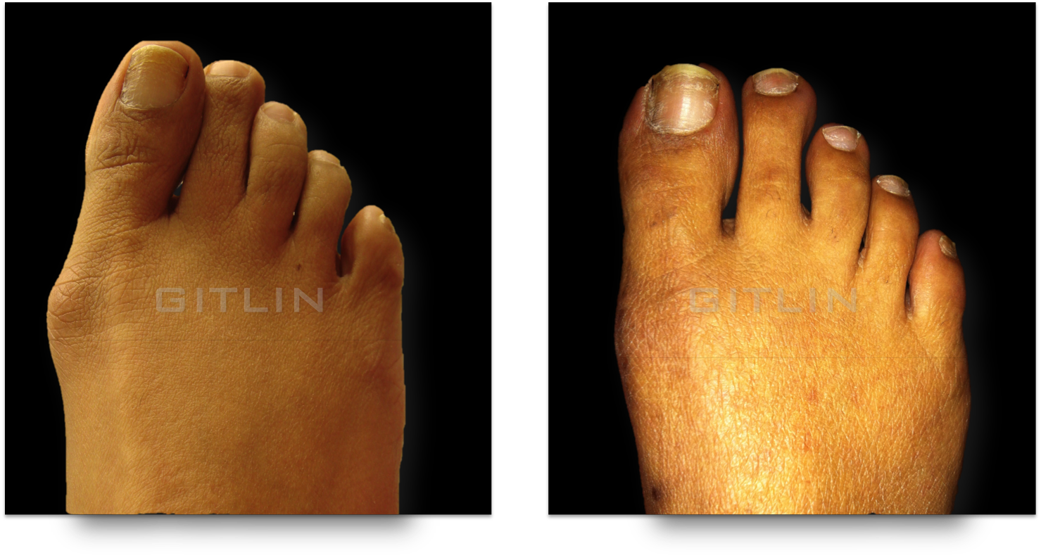 bunion7