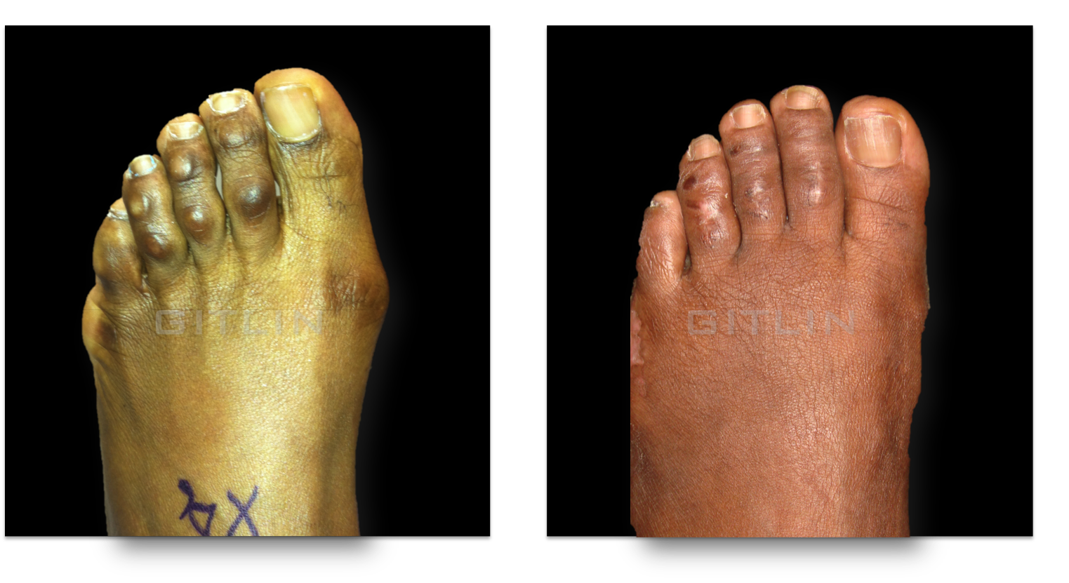 bunion8