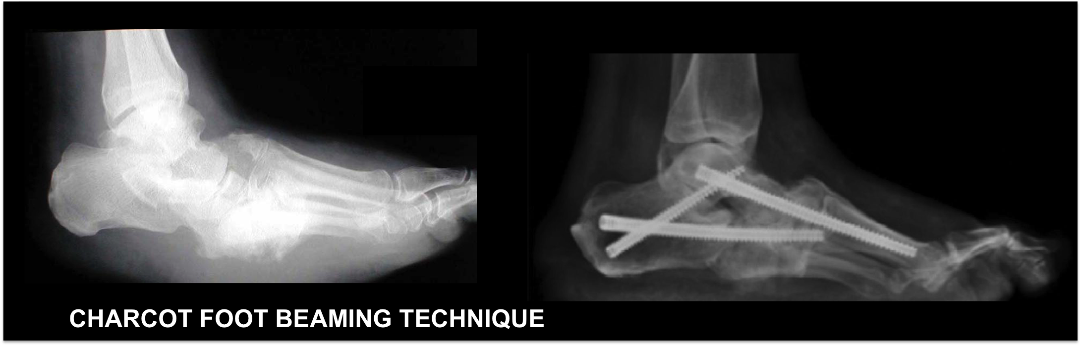 Charcot Foot Beaming Technique