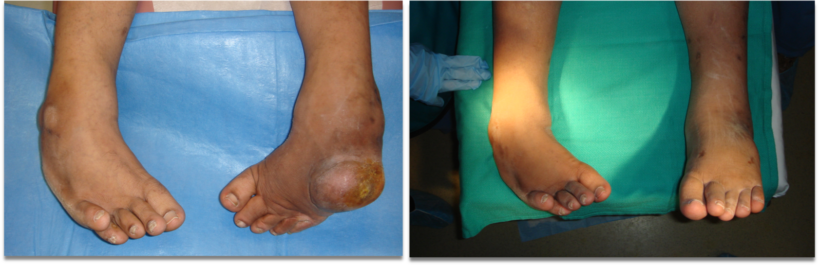clubfoot2