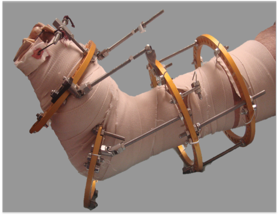 clubfoot3