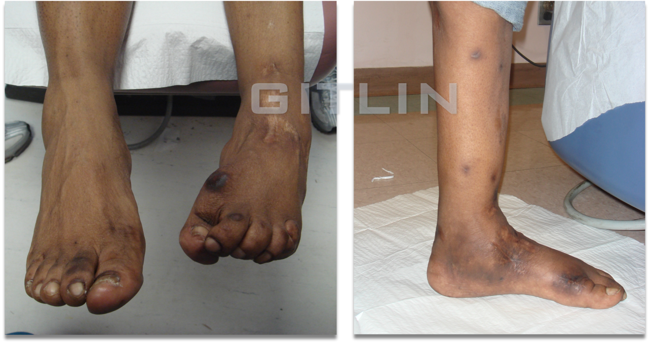 clubfoot5