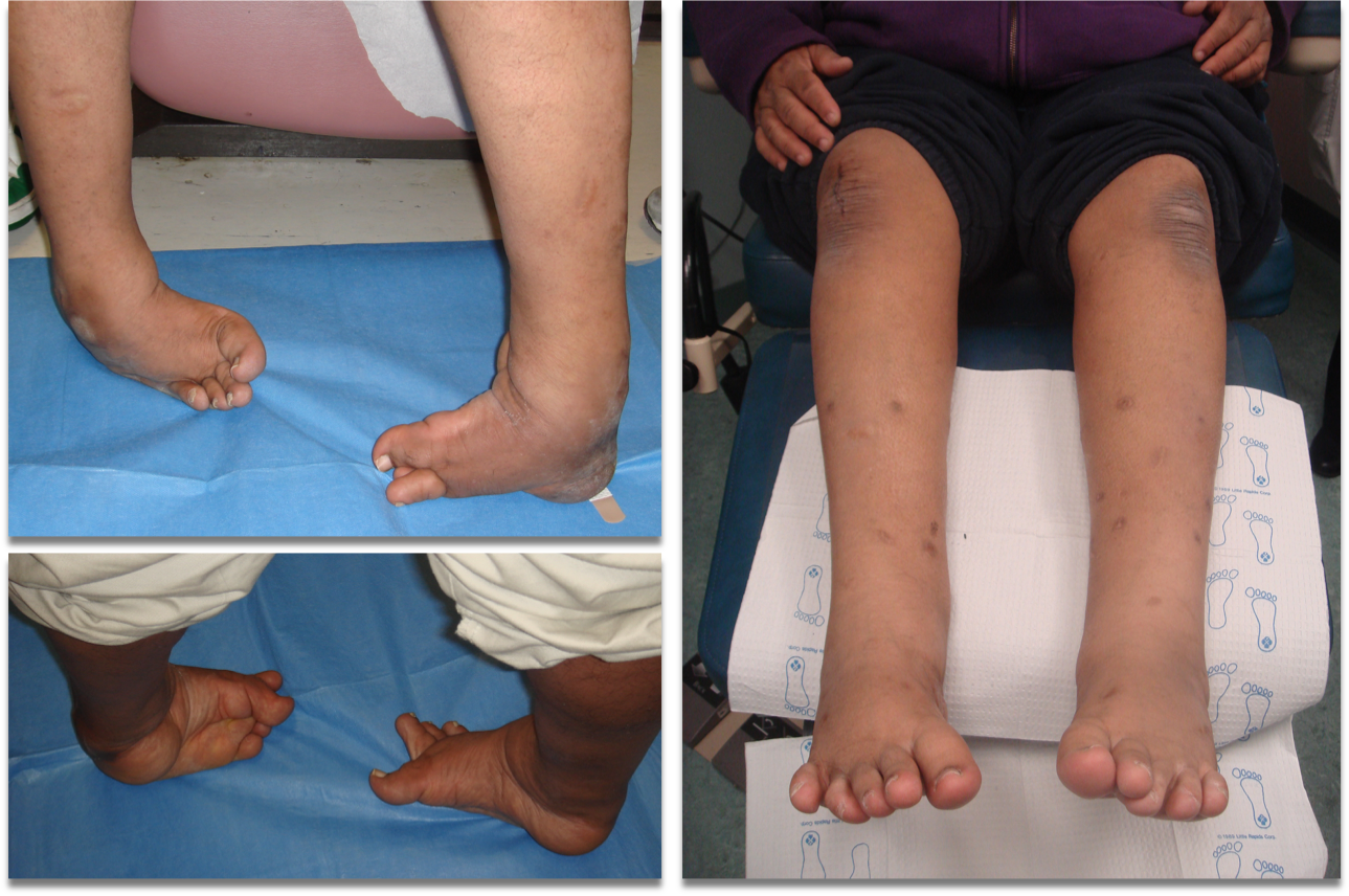 clubfoot6