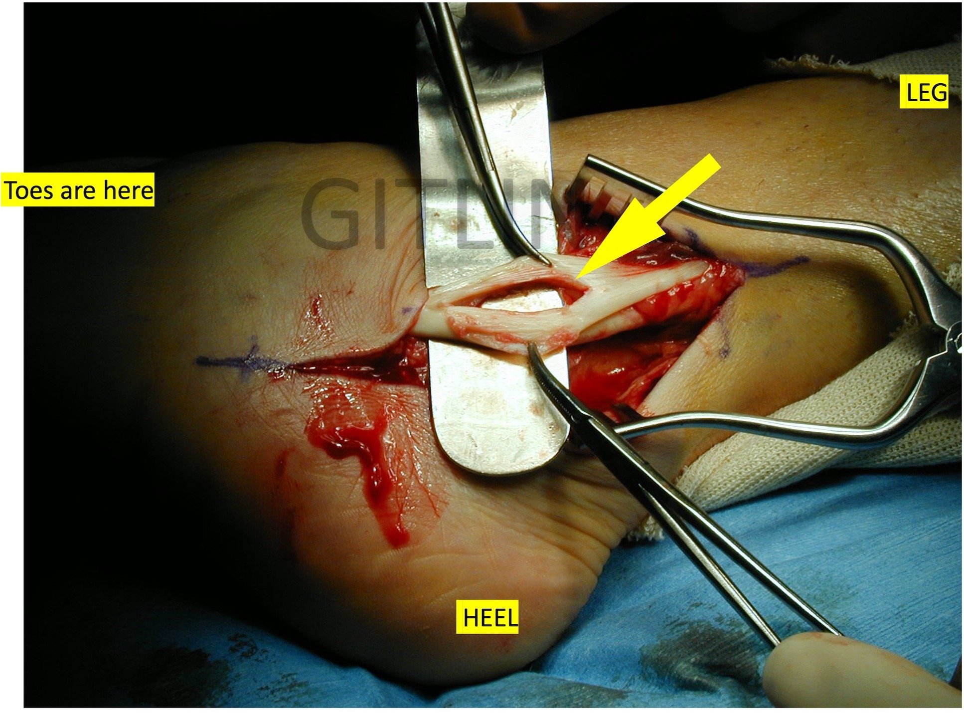 peroneal1