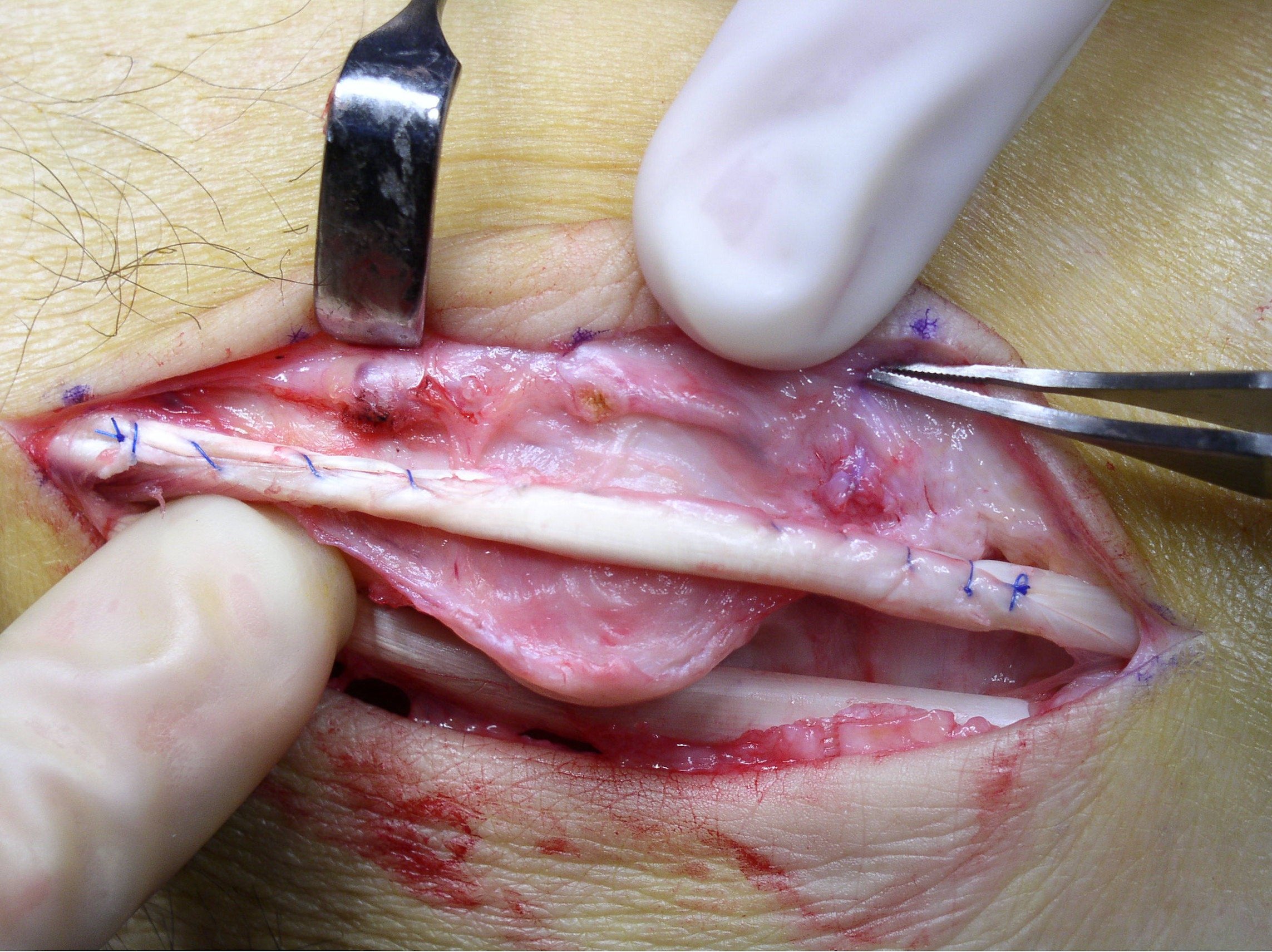 peroneal5