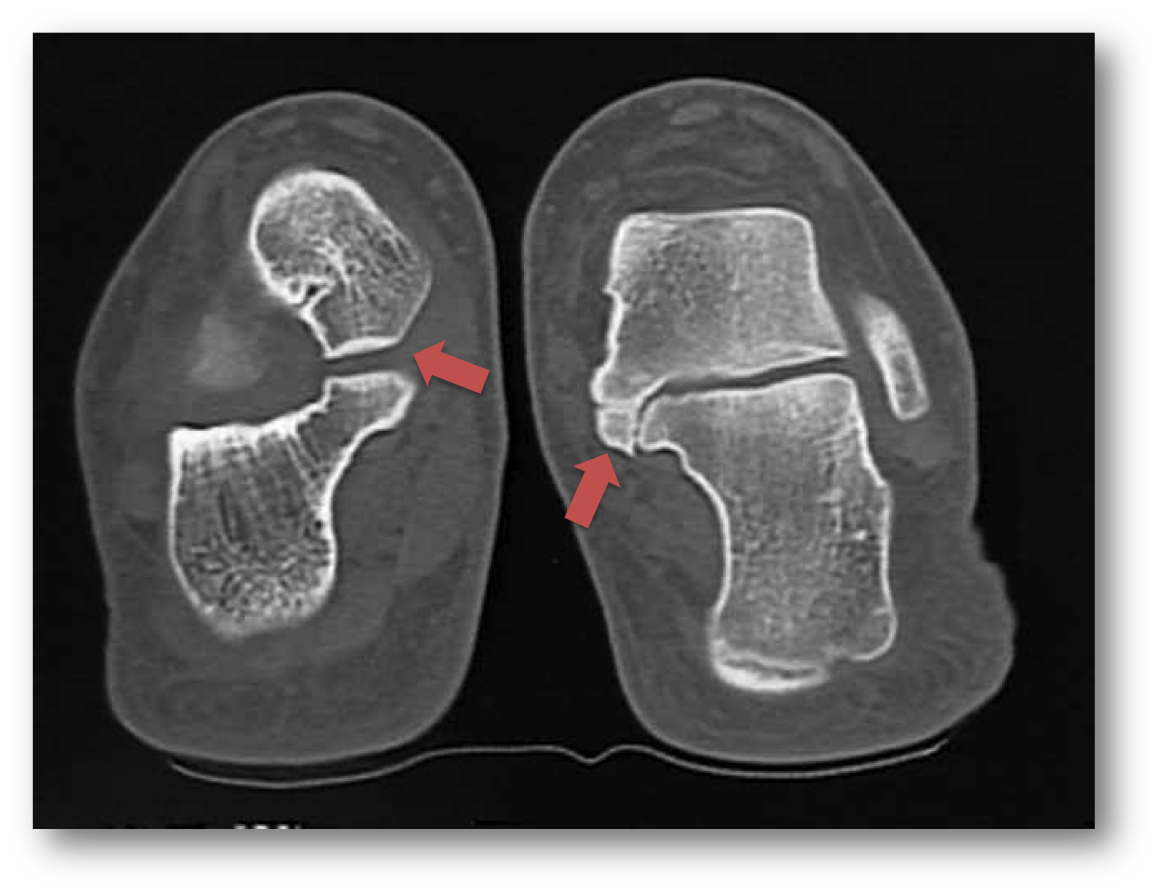 Tarsal Coalition1