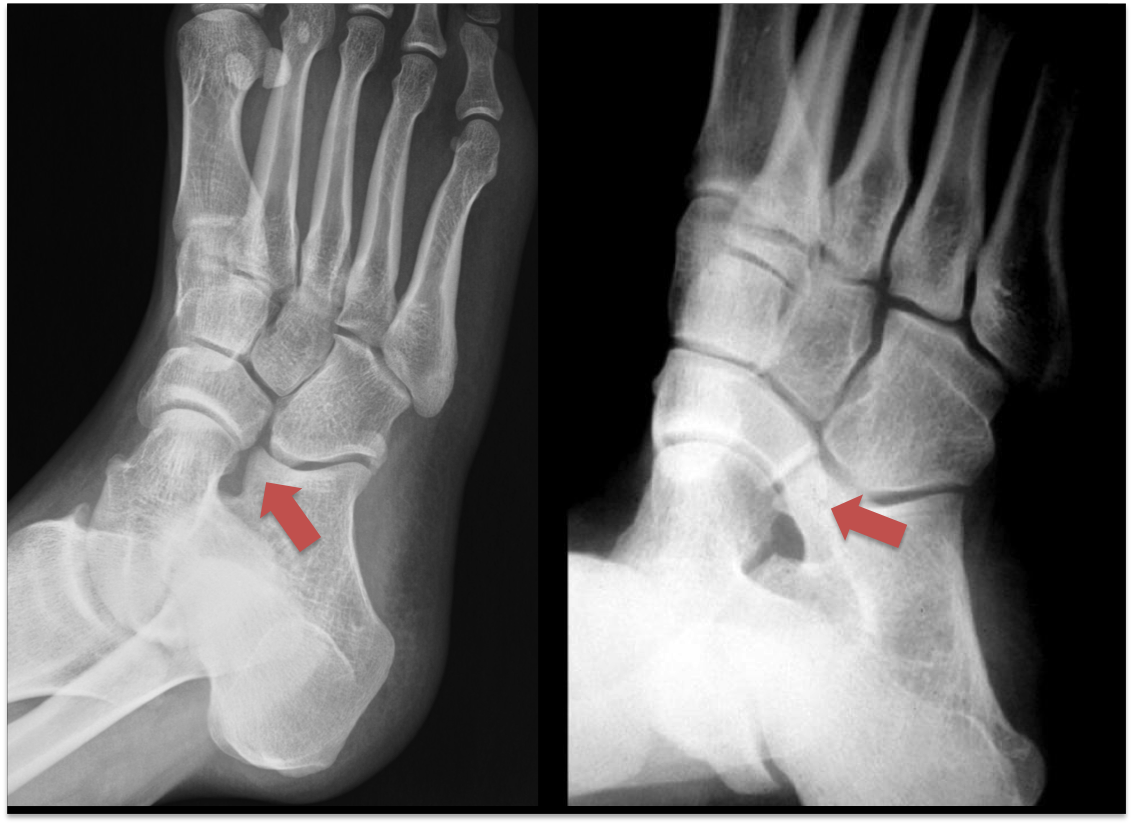 Tarsal Coalition2