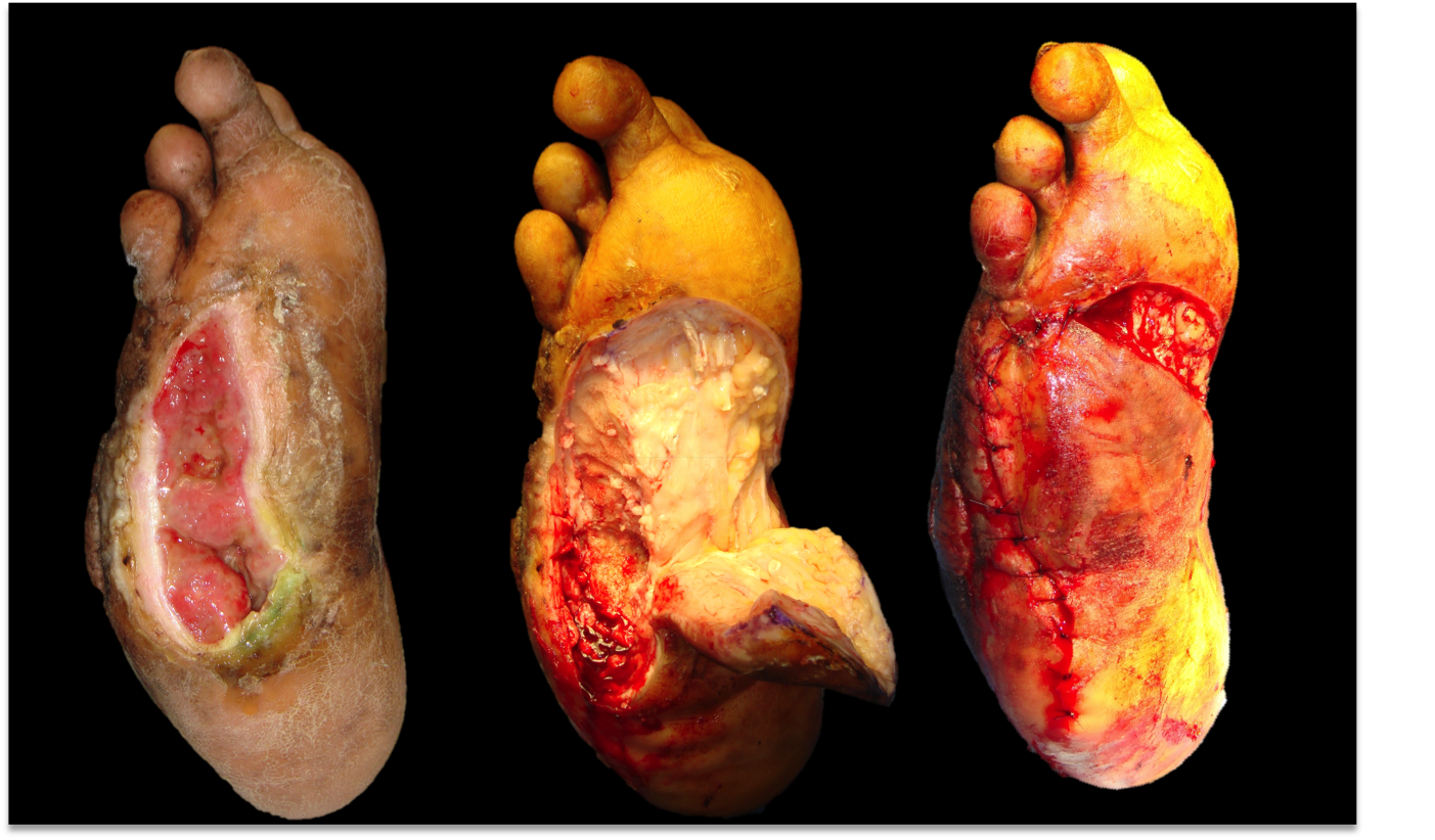 woundcare2