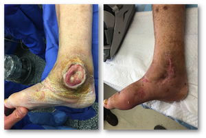 woundcare3